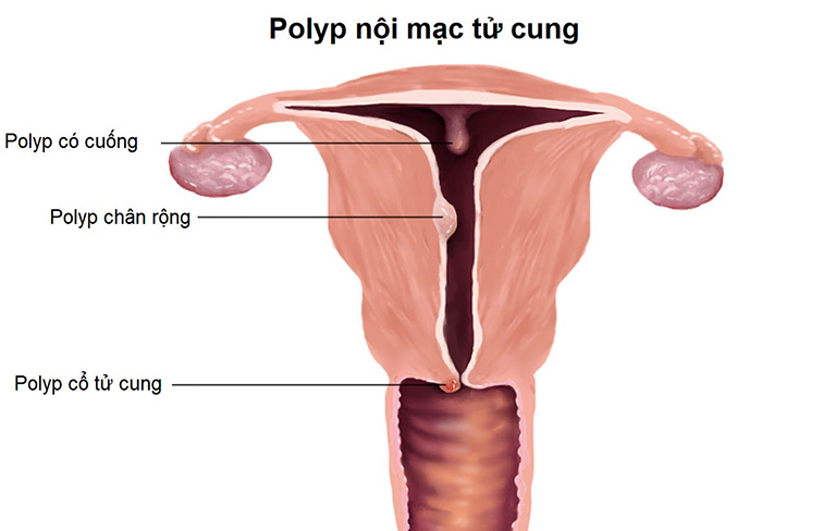 Đã mãn kinh bị ra máu có thể do polyp cổ tử cung