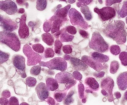 Viêm âm đạo do Gardnerella Vaginalis: Dấu hiệu nhận biết và cách điều trị dứt điểm 4 nu gioi bi viem am dao do vi khuan gardnerella
