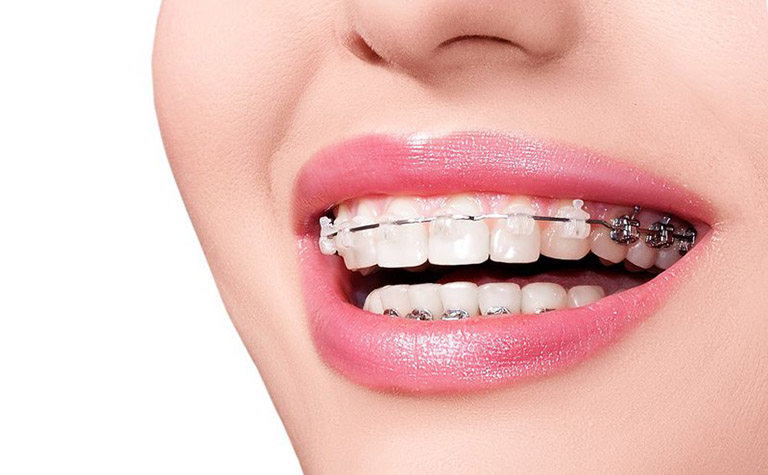 Răng hô hay còn gọi là răng vẩu là tình trạng nhiều người gặp phải