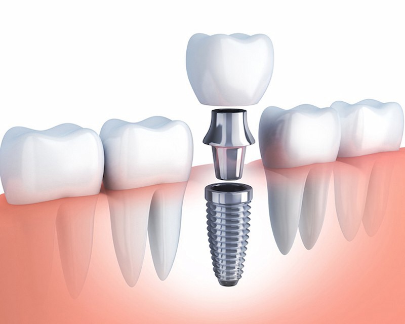 Trồng Răng Implant Có Đắt Không? Địa Chỉ Uy Tín - Trồng Răng Implant Không Đau